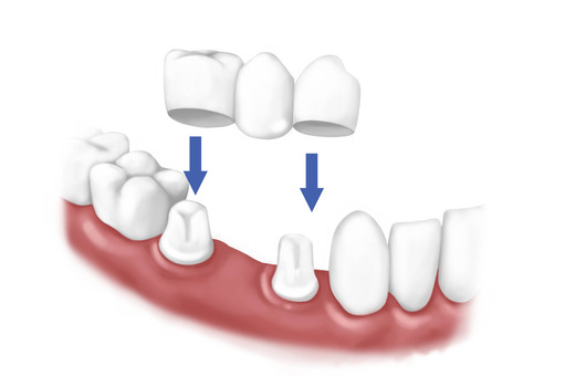 Dentist In Crowley TX - Teeth Whitening In Burleson TX.jpg
