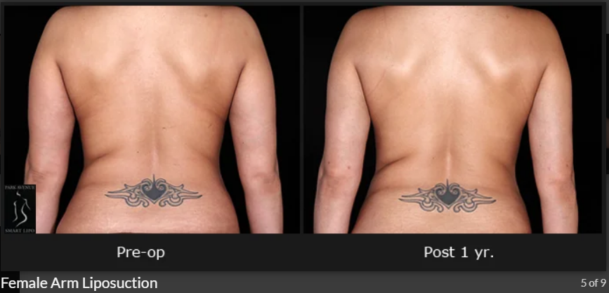 Female Arm Liposuction.png