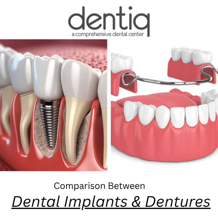Comparison Between Dental Implants & Dentures.png