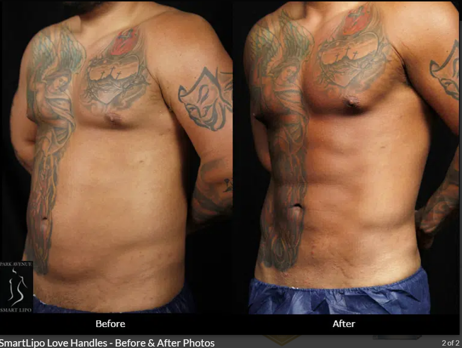 Smartlipo Love Hadles Liposuction - Before & After.png